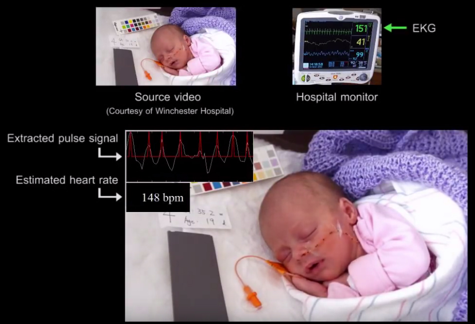 脈博訊號放大 150 倍的影像，可以透過血液流經臉部的膚色變化頻率，推估嬰兒脈博的速率。 圖│Revealing Invisible Changes In The World