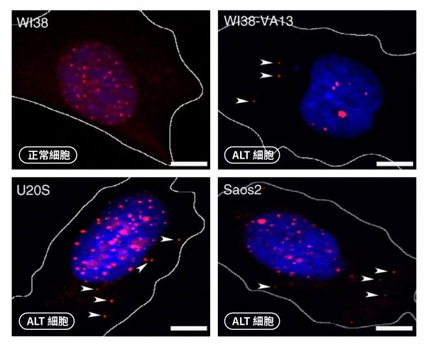 正常肺纖維母細胞（WI38），細胞質沒有 ECTR。但是 ALT 癌細胞（WI38-VA13、U2OS、Saos2）的細胞質存在 ECTR（箭頭處），ECTR 的存在沒有成功啟動免疫系統。 圖｜研之有物（資料來源｜陳律佑）